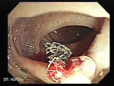 Polyp Inside Of A Diverticulum (12 of 12)