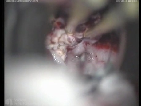 Intraventricular Ependymoma - Frontal Transsulcal Approach
