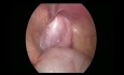 Bilateral Laparoscopic Orchiopexy
