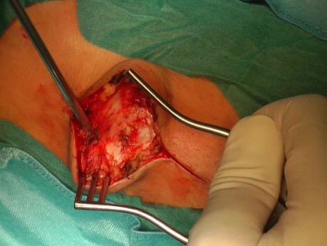 Neuroma of the Peroneal Nerve
