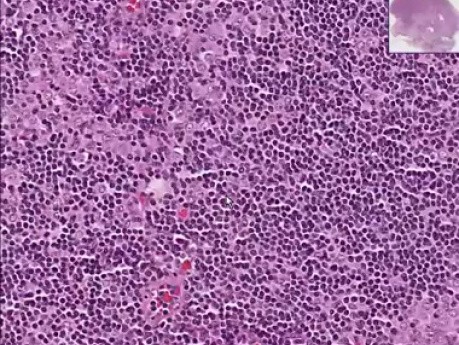 Metastatic breast carcinoma
