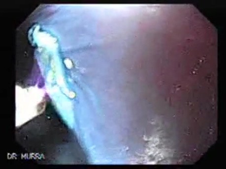 Barrett's Esophagus of long segment (10 of 24)