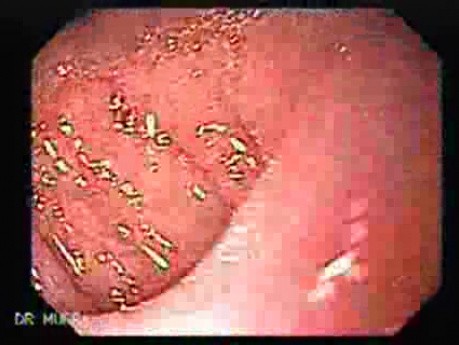 Gatsric Adenocarcinoma of the Lesser Curvature After Gastrectomy Billroth II (3 of 3)