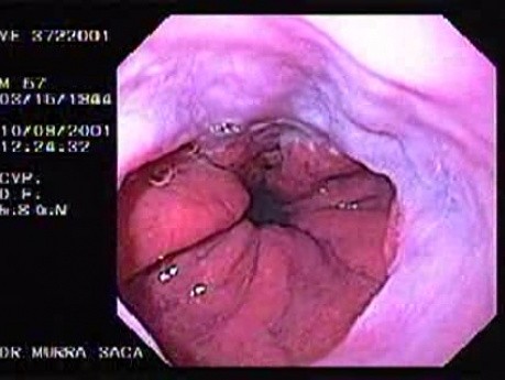 Sliding Hiatal Hernia