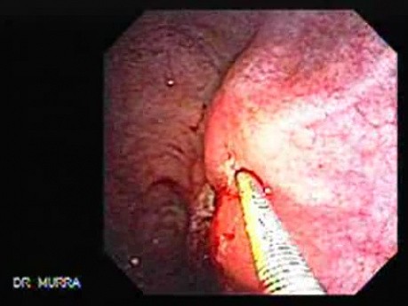 Gastric Cicatrization With Pylorus Stenosis (15 of 23)