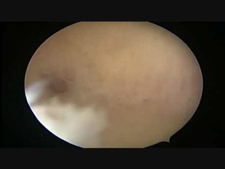 Bubble Test In Hystorscopy