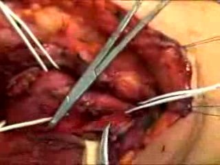 The Carotid Body tumor