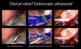 First-in-man AI-assisted Augmented Reality Surgery