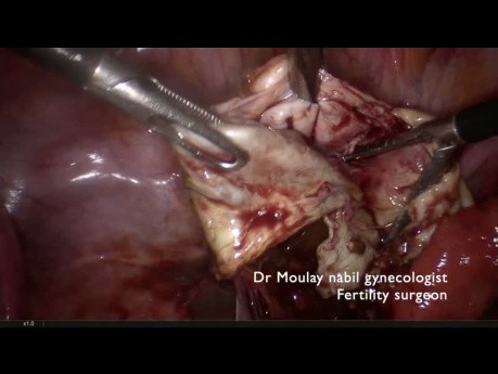 Fertility Sparing Endometrioma Cystectomy