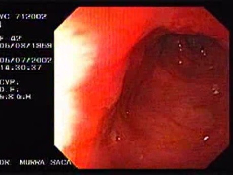 Crohn's Disease - Endoscopy (21 of 28)