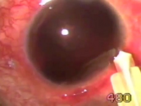 Traumatic blackball hemorrhage management