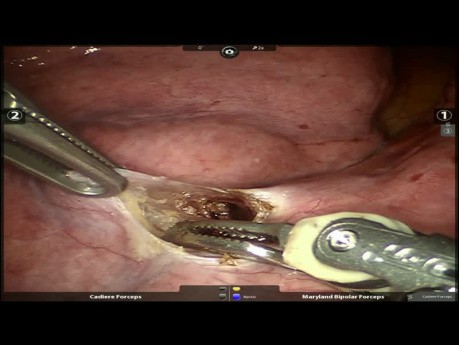 Left Lower Robotic Lobectomy