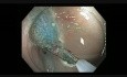 Colonoscopy - Transverse Colon Subtle Flat Lesion in a Diverticulum
