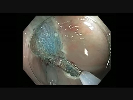 Colonoscopy - Transverse Colon Subtle Flat Lesion in a Diverticulum