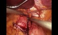 Laparoscopic Banded Gastric Bypass