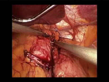 Laparoscopic Banded Gastric Bypass