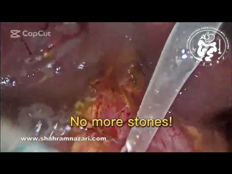LCBD Exploration & Re-anastomosis