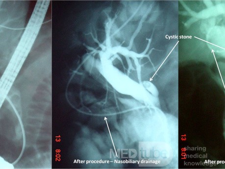 Endoscopic Litotripsy