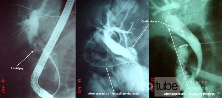 Endoscopic Litotripsy