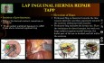Laparoscopic Inguinal Hernia Repair - Operative Surgery