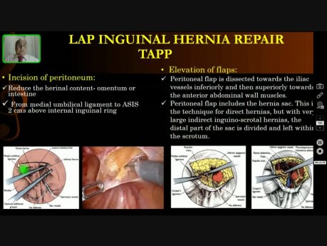 Laparoscopic Inguinal Hernia Repair - Operative Surgery