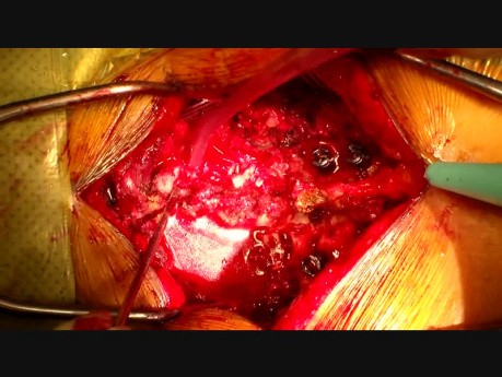 Cervical Laminectomy
