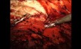 Robotic eTEP with Unilateral eTAR for Abdominal Wall Hernia Repair, Surgical Technique