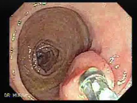 Colonic Lipoma (2 of 3)