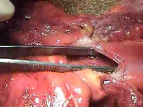 Multiple Rectal Ulcers (63 of 110)