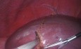 The Effects of Laparoscopic Liver Resection on Cardiopulmonary Performance