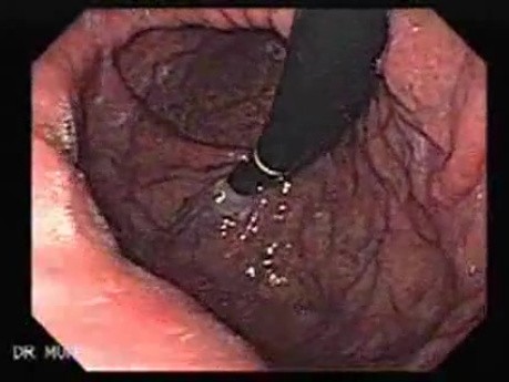 Esophageal Varices and Hiatus Hernia (1 of 3 )