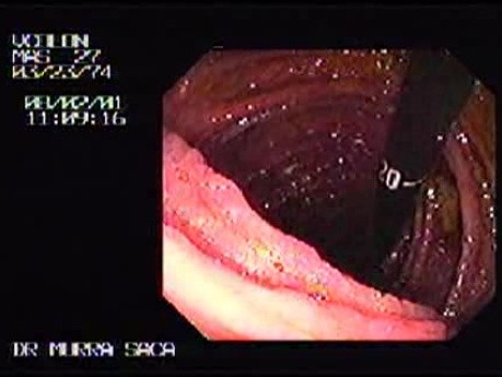 Familial Adenomatous Polyposis of the Colon (6 of 29)