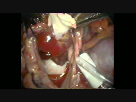 Excision of Left Atrial Myxoma by Minimally Invasive Technique