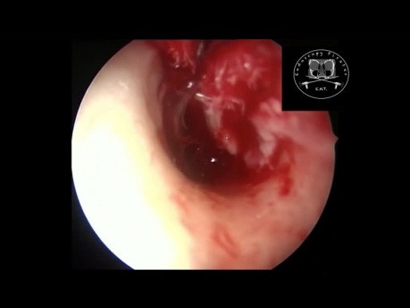 Endoscopic Myringoplasty