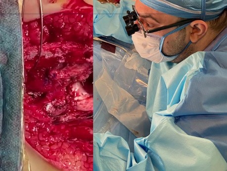 Off Pump Fontan Operation for the First Time Case Series 