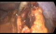 Laparoscopic Subtotal Colectomy, Inflammatory Bowel Disease