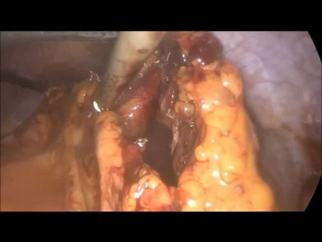 Laparoscopic Subtotal Colectomy, Inflammatory Bowel Disease