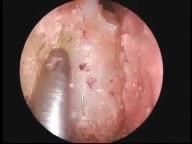 Ear, nose and throat surgery
