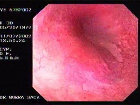 Evolution of a Gastric Carcinoma without a Treatment (6 of 10)