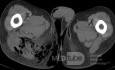 Soft Tissue Necrosis ON CT scan