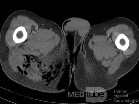 Soft Tissue Necrosis ON CT scan