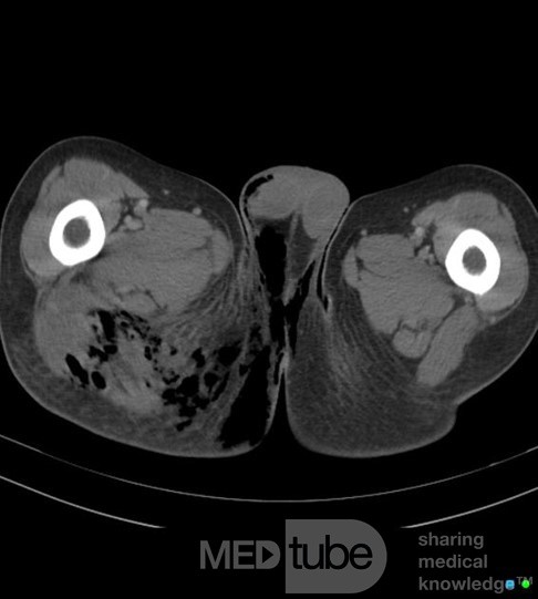 Soft Tissue Necrosis ON CT scan