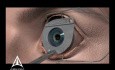 Lasik Surgery - 3D Medical Animation 