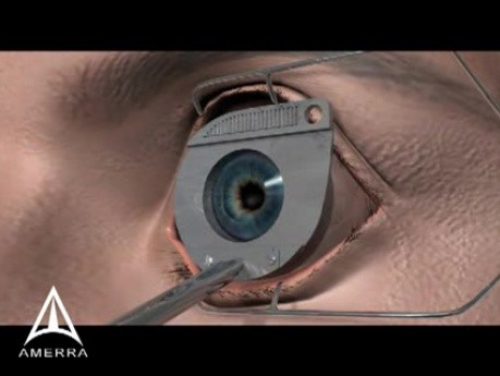 Lasik Surgery - 3D Medical Animation 