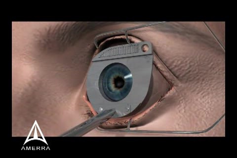 Lasik Surgery - 3D Medical Animation • Video • 