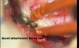 Spinal Cord Tumor - Intra Dural Meningioma - Microsurgery