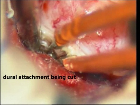 Spinal Cord Tumor - Intra Dural Meningioma - Microsurgery