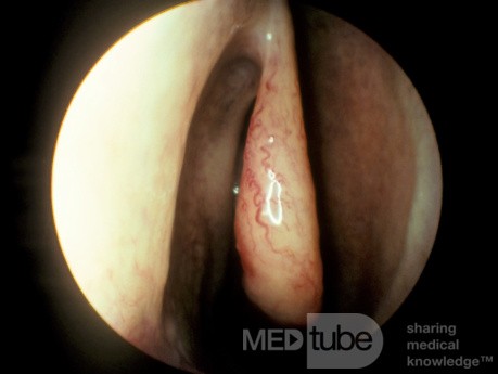 Normal Right Middle Turbinate