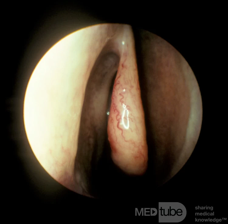 Normal Right Middle Turbinate
