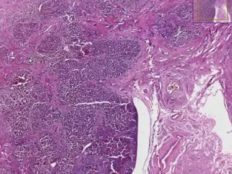 Primary biliary cirrhosis - Histopathology  - Liver